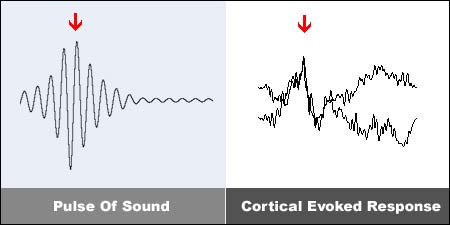 cortical evoked response